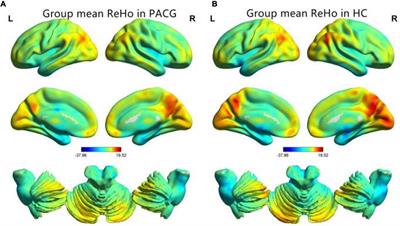 The Predictive Values of Changes in Local and Remote Brain Functional Connectivity in Primary Angle-Closure Glaucoma Patients According to Support Vector Machine Analysis